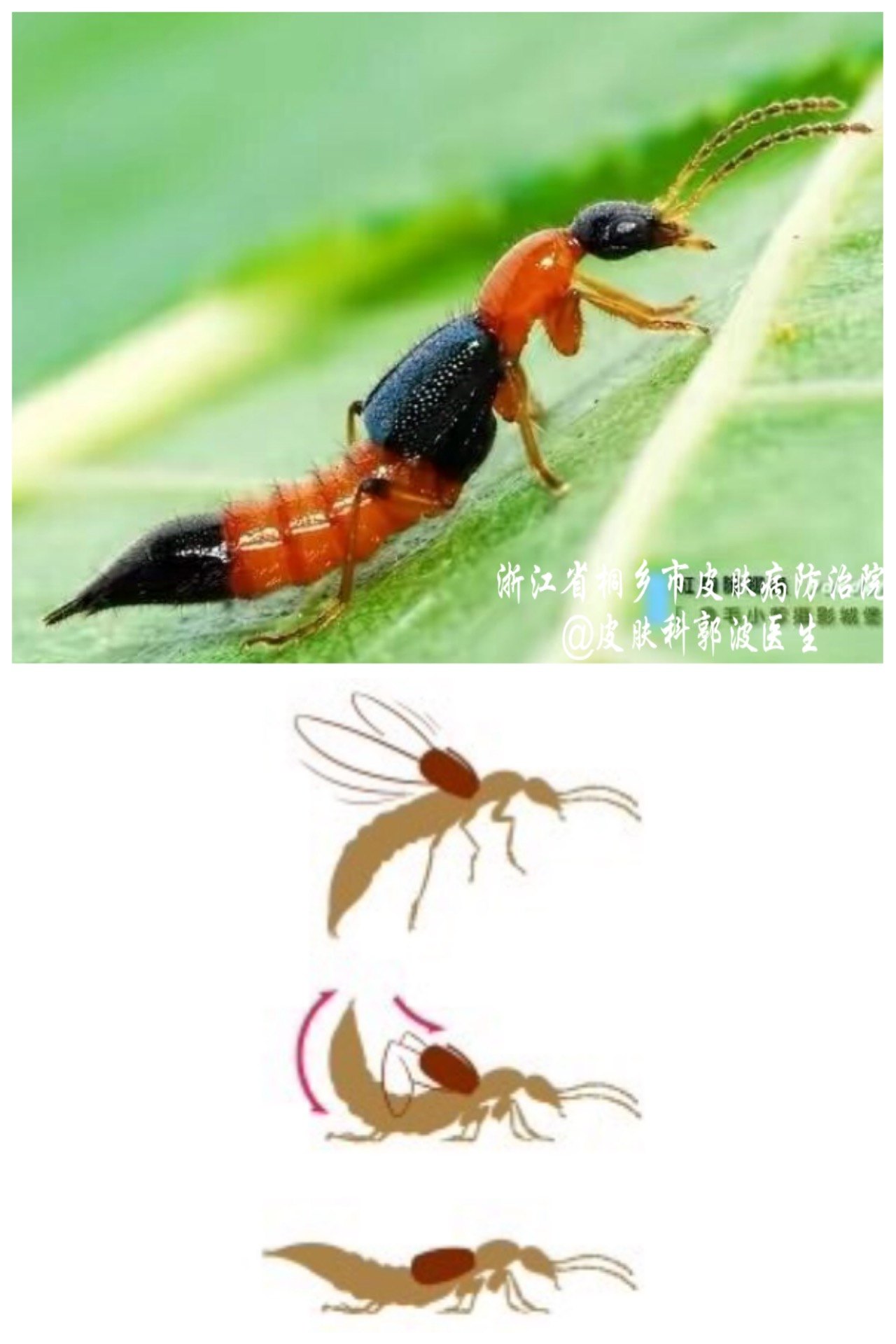 隐翅虫皮炎其实很常见