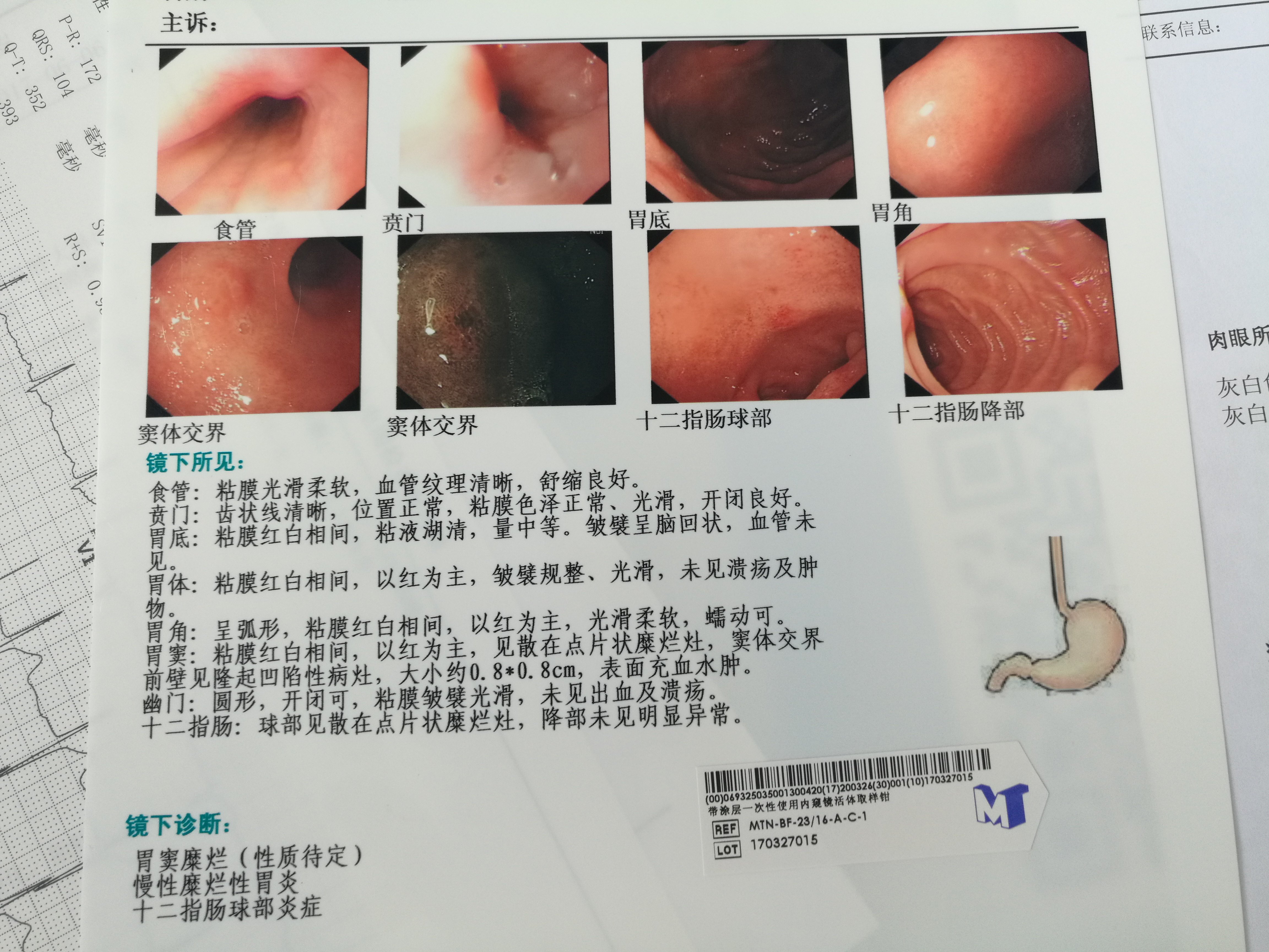 一个病人从萎缩性胃炎到胃癌的历程