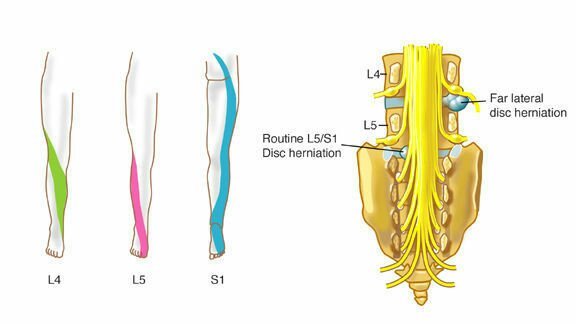 腰腿疼痛不止是腰椎间盘突出症 也可能是它 腰腿痛 腰腿痛病因
