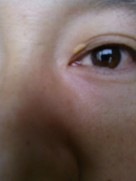眼睑皮脂腺瘤图片