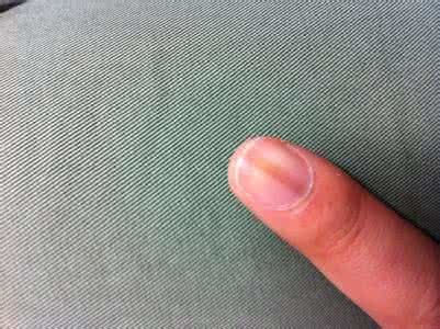 甲下黑线是恶性肿瘤吗(高清图文)? - 好大夫在线