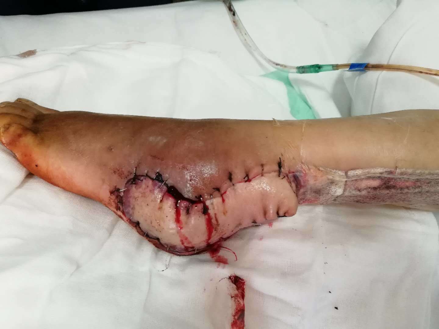 糖尿病患者骨折术后钢板外露的皮瓣修复 - 好大夫在线