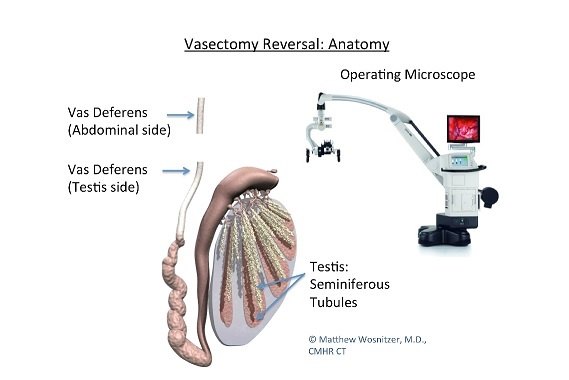 梗阻性无精子症,治疗选择的奥秘