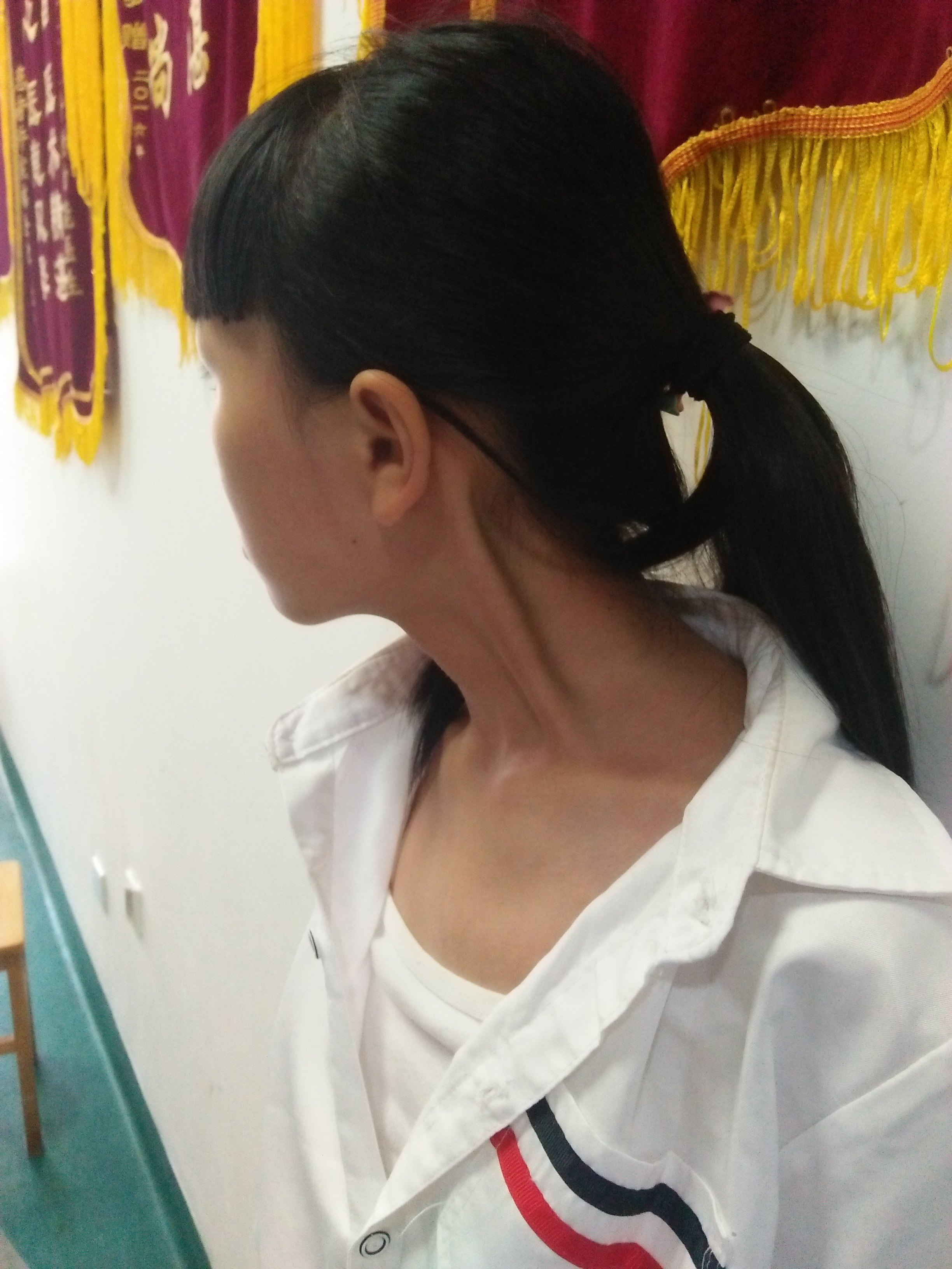 斜颈诊疗误区(一) - 好大夫在线