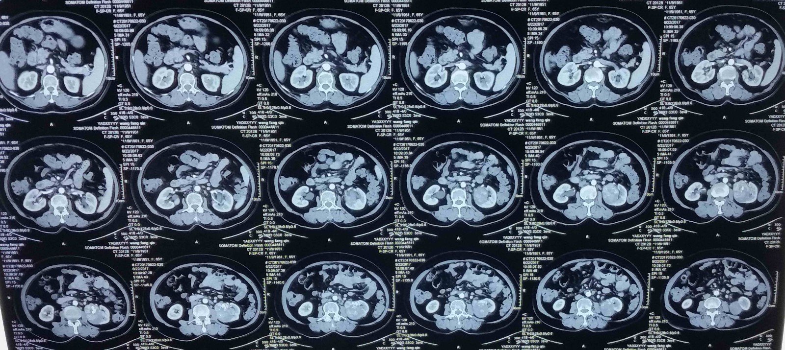 后腹腔镜左肾肿瘤剜除术