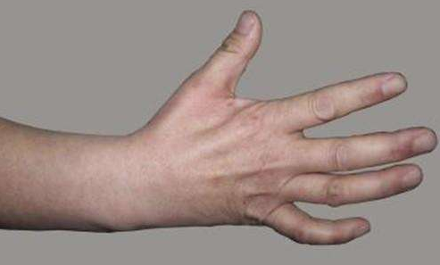 手指伸不直,当心"糖尿病手"