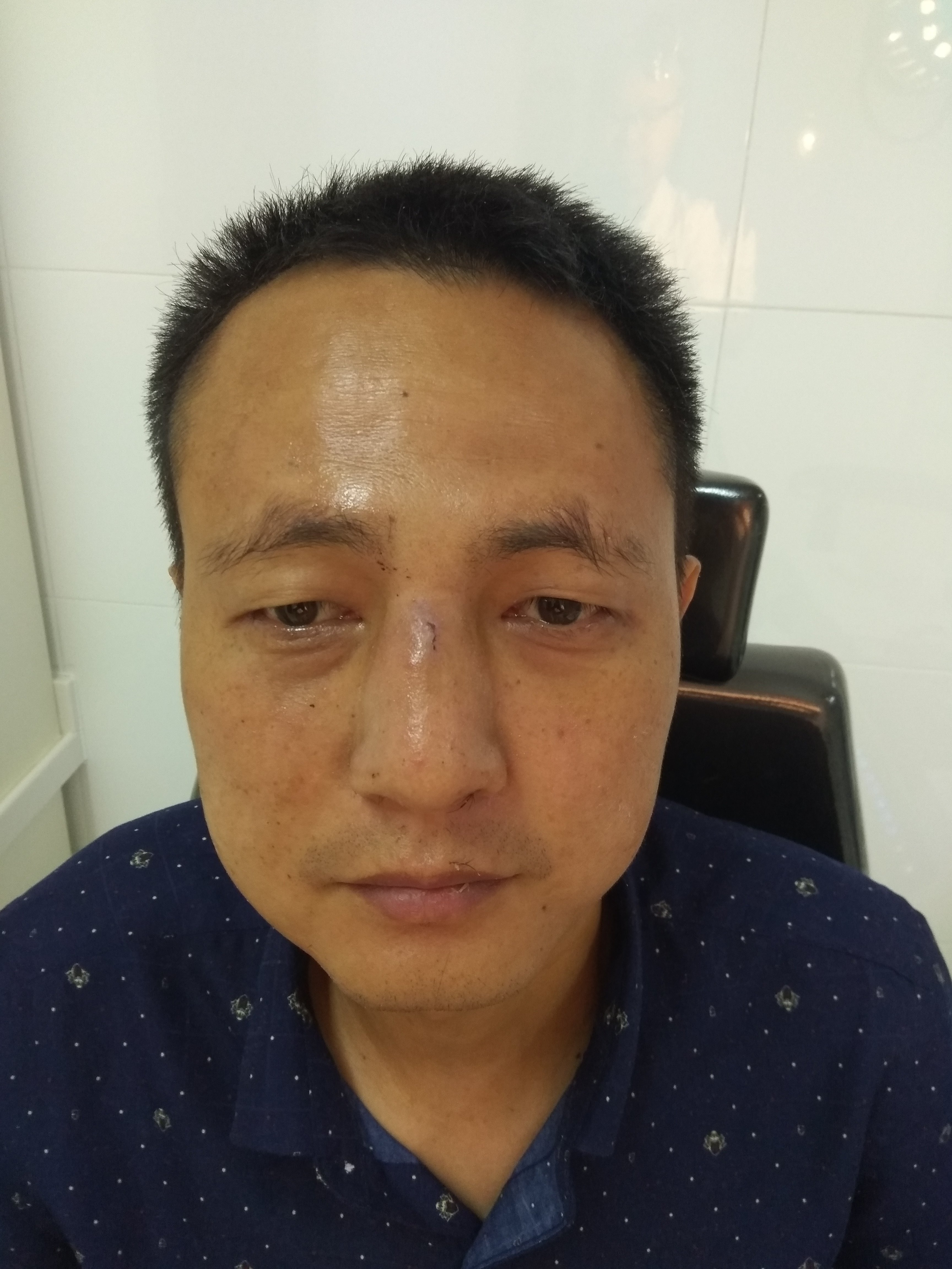 新鲜鼻骨骨折局麻下矫正 新鲜鼻骨骨折局麻下矫正