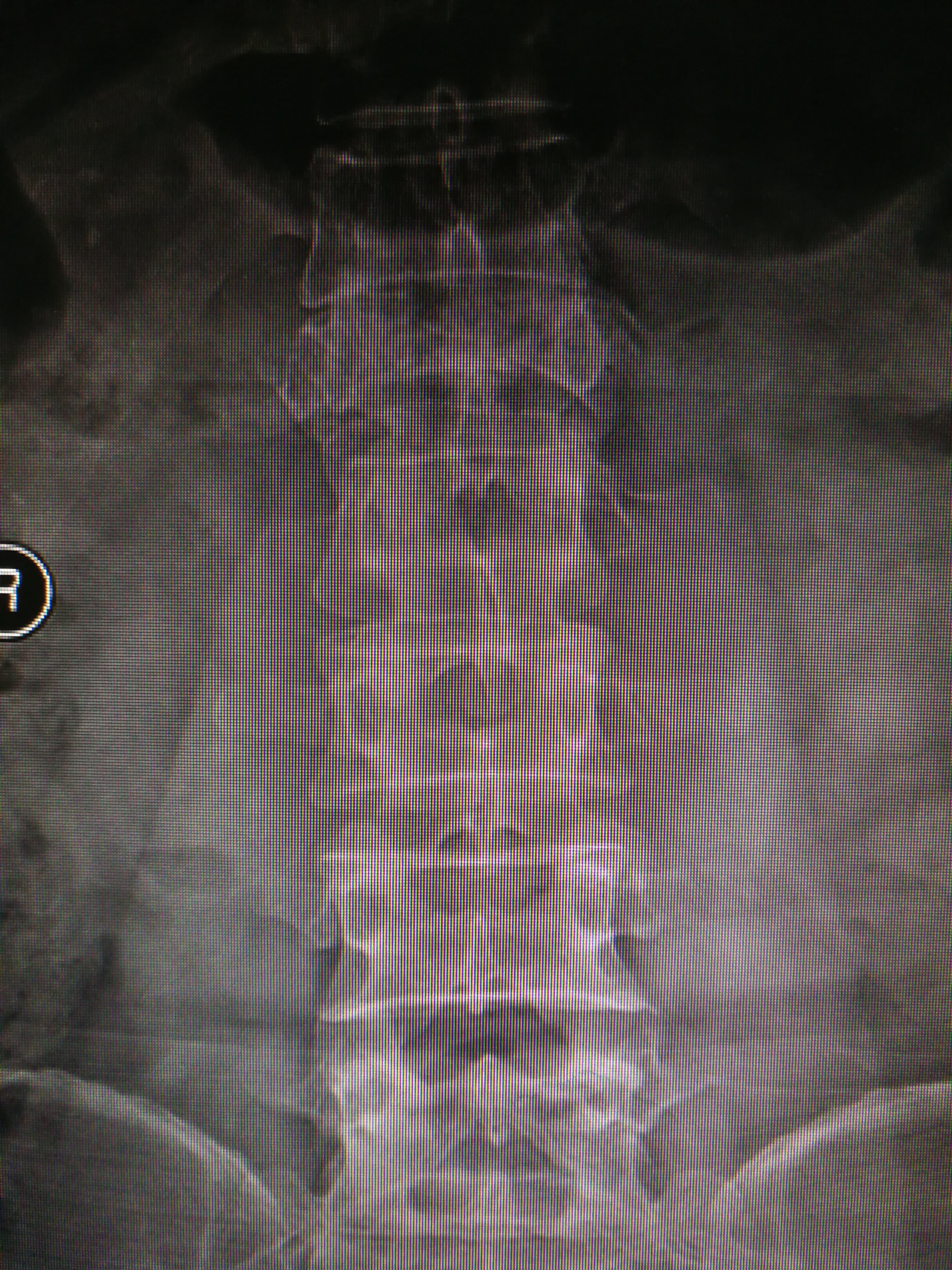 胸腰椎爆裂性骨折并不全瘫手术治疗