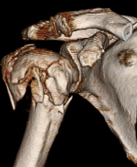 肩胛骨骨折分型解剖图图片