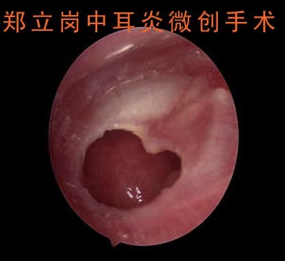 前言:中耳炎微創手術是目前治療慢性化膿性中耳炎及膽脂瘤型中耳炎最