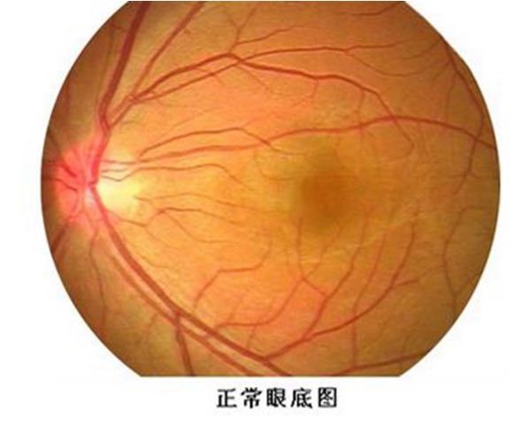 糖尿病控制不好会失明,这是咋回事?