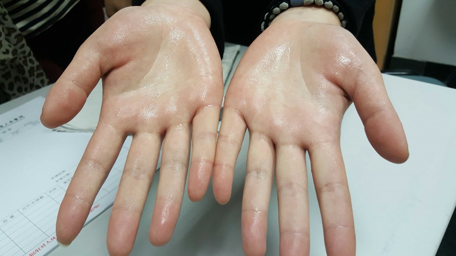 广东省人民医院胸外科张冬坤博士回复手汗症微创手术治疗咨询_手汗症