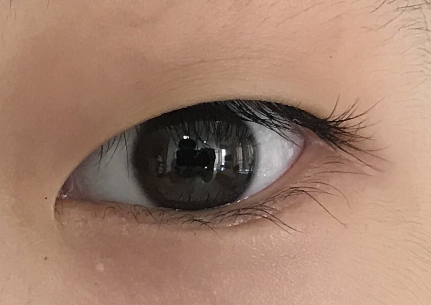 为什么倒睫需要手术治疗? - 好大夫在线