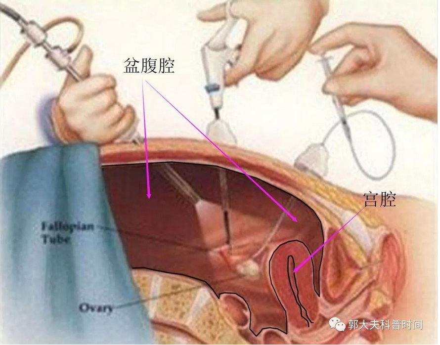 子宫全切手术图步骤图片