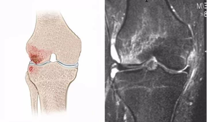 膝关节外伤 对膝关节损伤诊断极为重要的外伤性骨髓水肿
