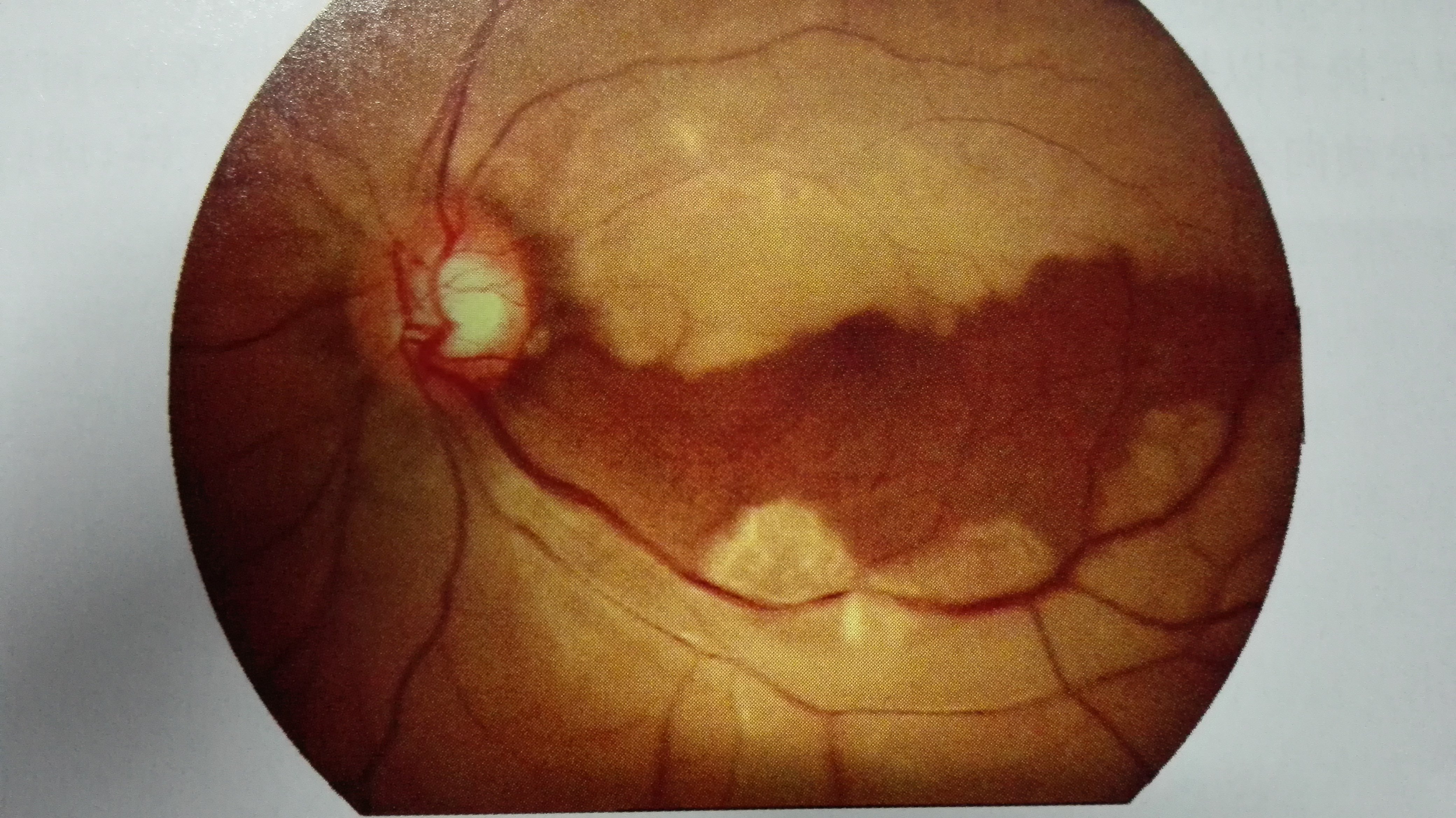 揭开视网膜中央动脉阻塞的真面目