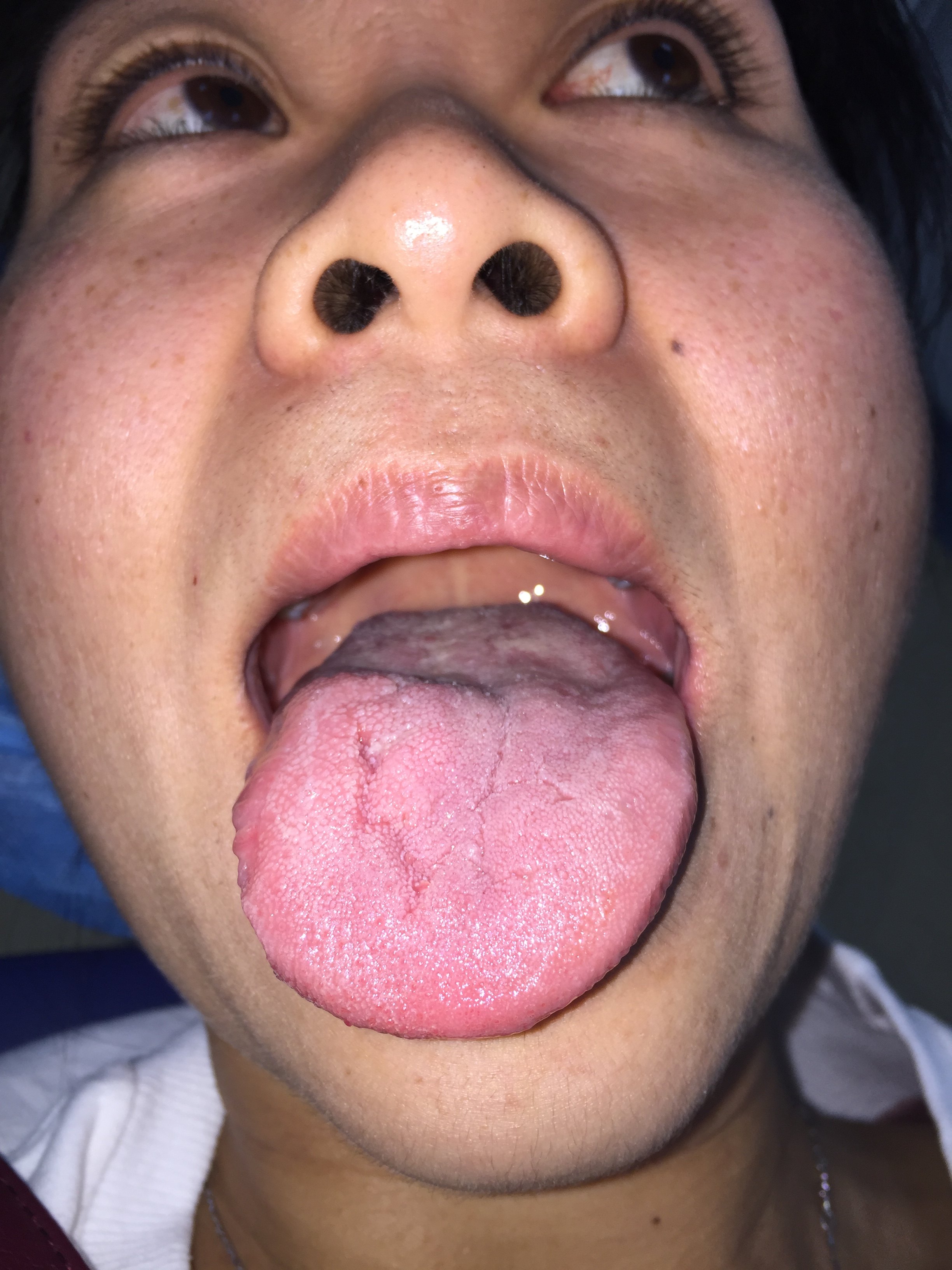 舌肿瘤的功能性手术切除 - 好大夫在线