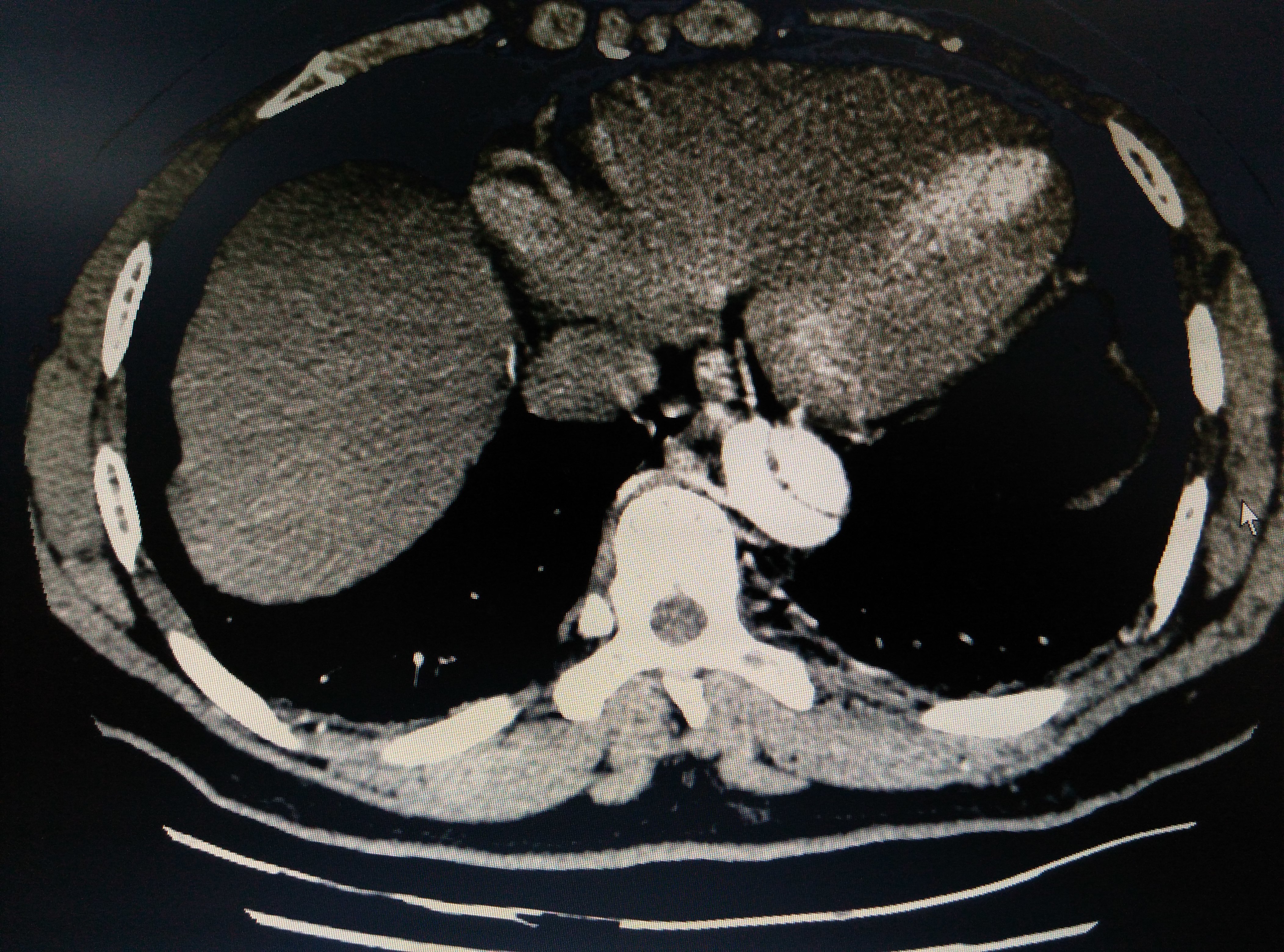 秋冬季谨防主动脉夹层