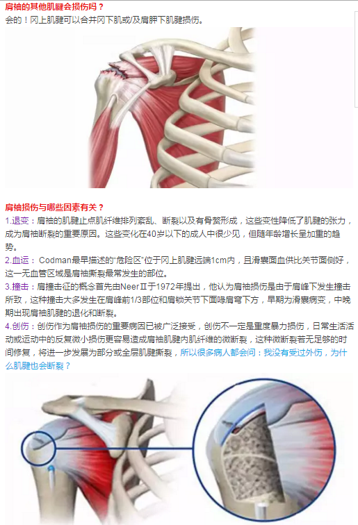 肩袖損傷中老年肩關節疼痛的主要原因