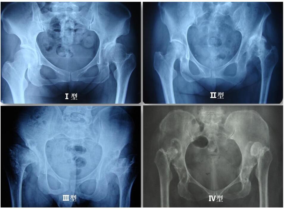 图2-6-1Ⅰ型Ⅳ型股骨头脱位的x片表现.jpg