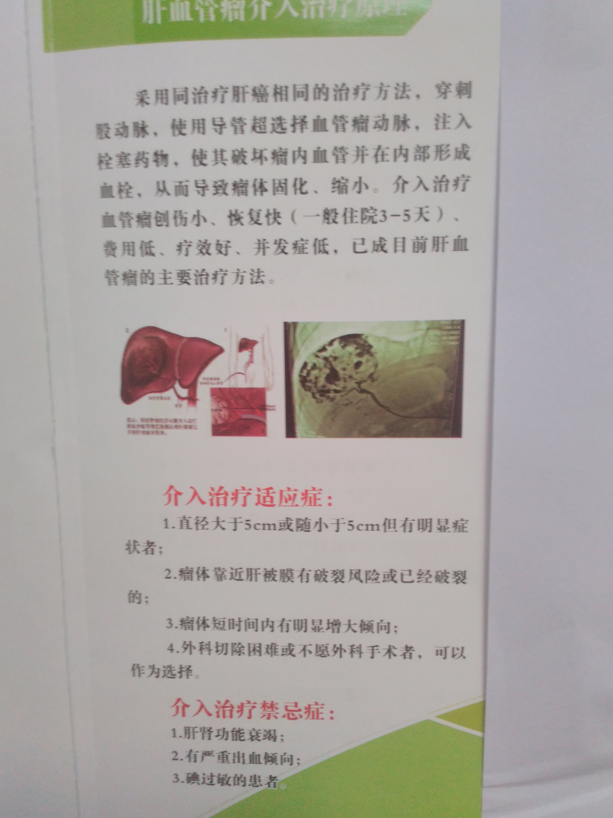 肝血管瘤介入微创治疗