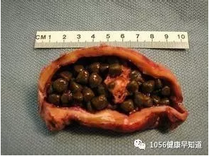 无症状胆囊结石也不能掉以轻心,听听专家怎么说