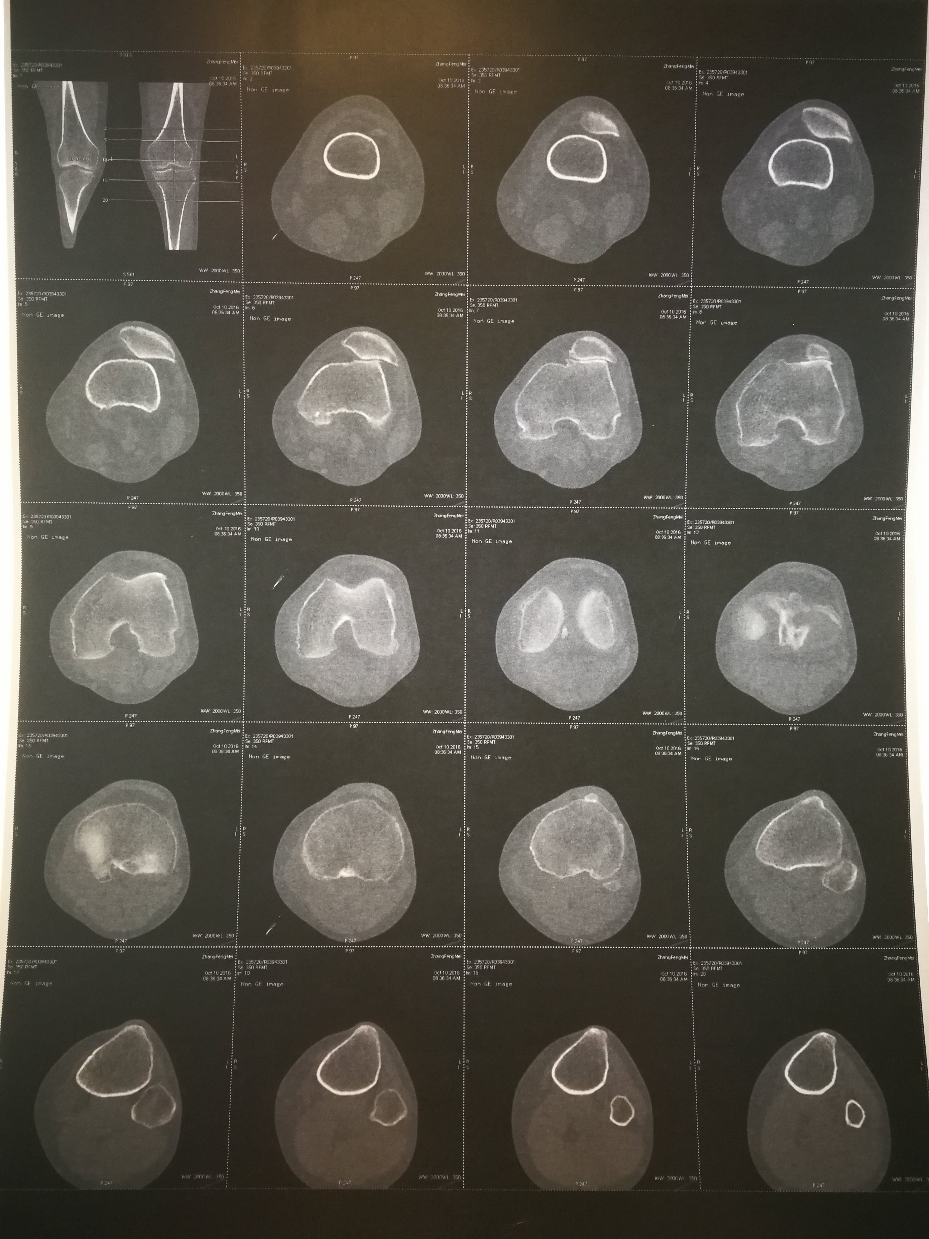 高位髕骨髕股關節炎脛骨結節移位術