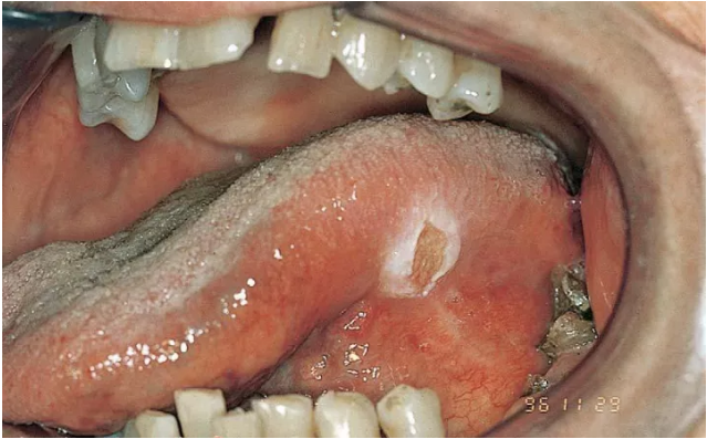 舌系带溃疡图片