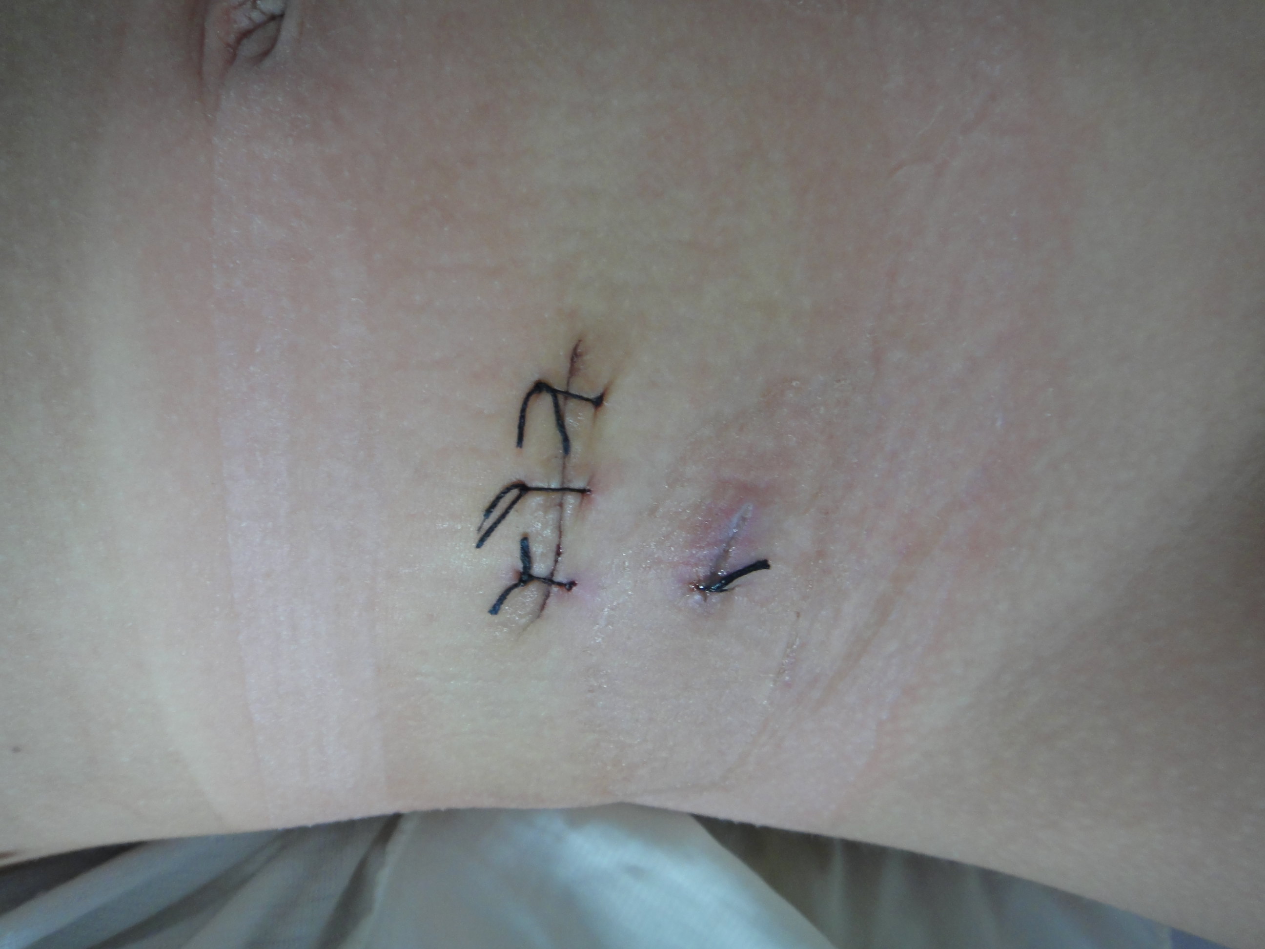 阑尾炎手术后疤痕位置图片