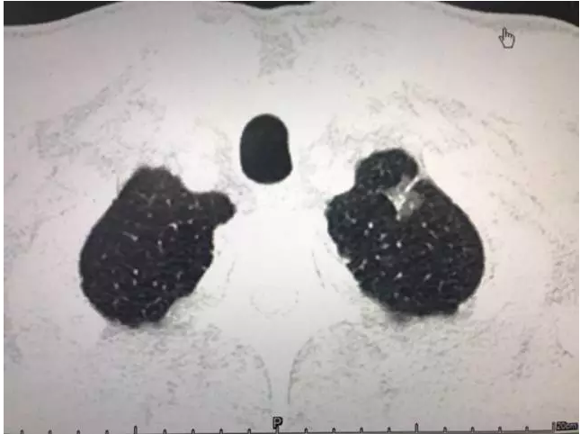 肺磨玻璃结节(GGO)(转发) - 好大夫在线