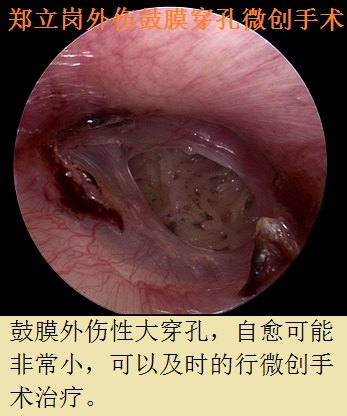 外傷性鼓膜穿孔耳內鏡微創手術第446廣東佛山南海郭