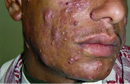 痤疮图片及治疗方法【图片可能会使您感到不适请谨慎点击】