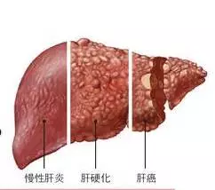 肝癌高危人群如何预防?甲胎蛋白什么时候检查