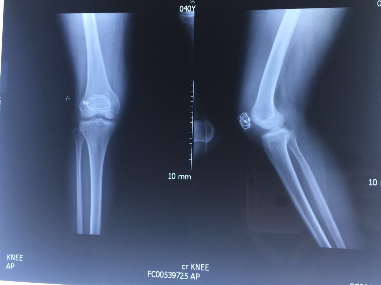 【病例分享】mua處理髕骨骨折內固定術後膝關節粘連