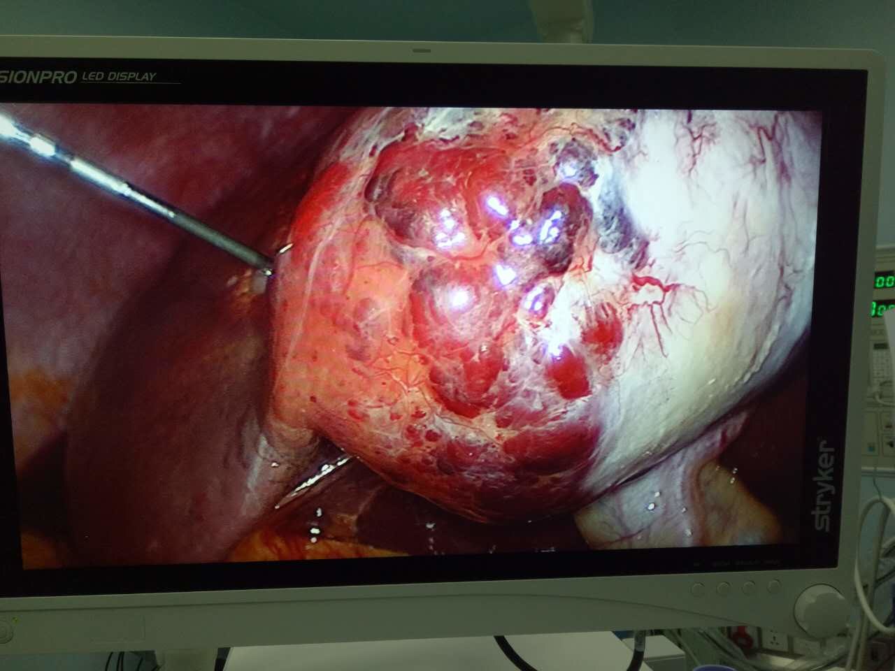 由于患者较年轻,且 血管瘤增大趋势明显,故有手术指征