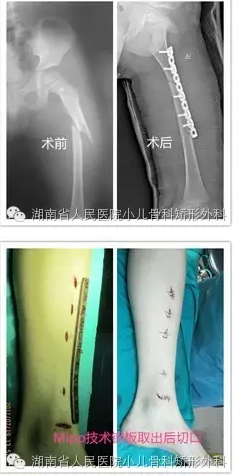 儿童骨折不可怕