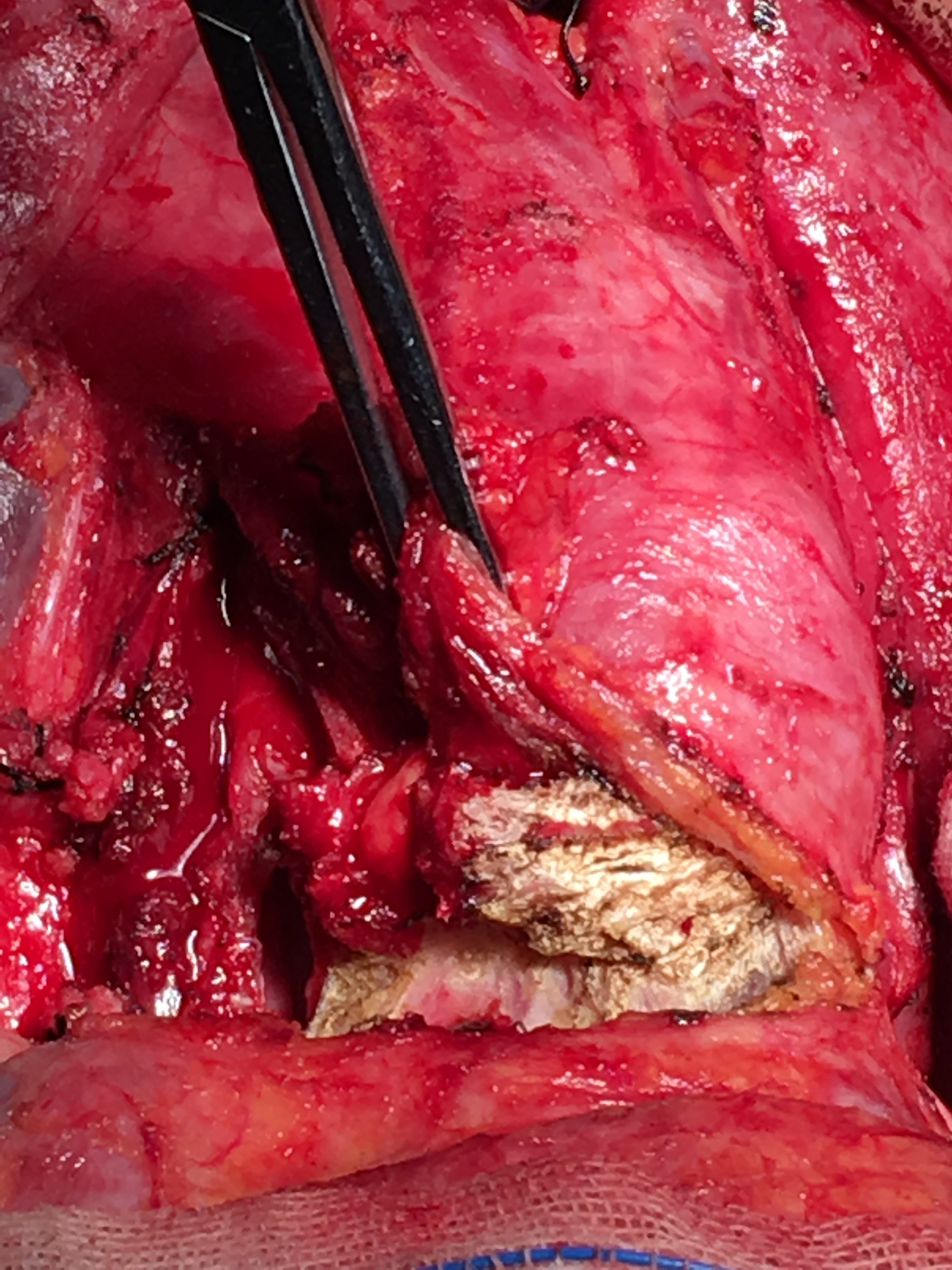 喉癌异物感会时有时无码_喉咙异物感一个月喉癌_喉癌异物感一直在一个位置吗