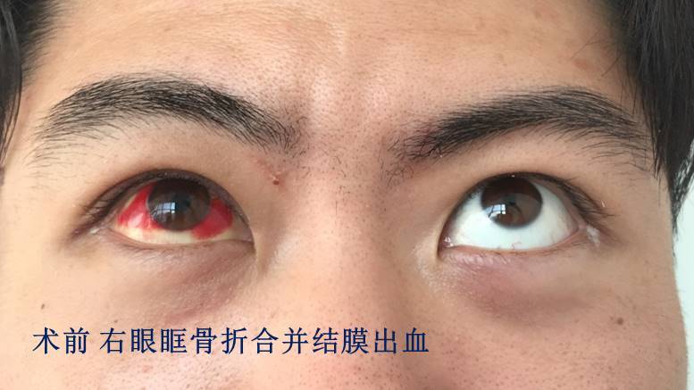 眼眶骨折术后眼白发黄发红多久能恢复?