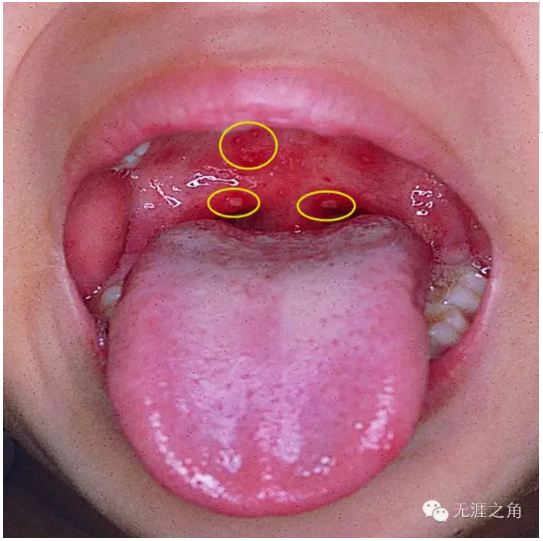儿童疱疹性咽峡炎过程图片