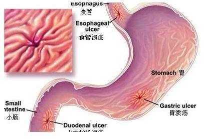 打嗝反酸用一植物泡水, 专治胃炎胃溃疡, 转给有