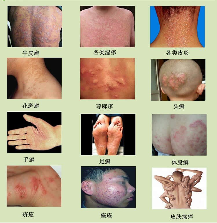 不同湿疹类型及图片图片