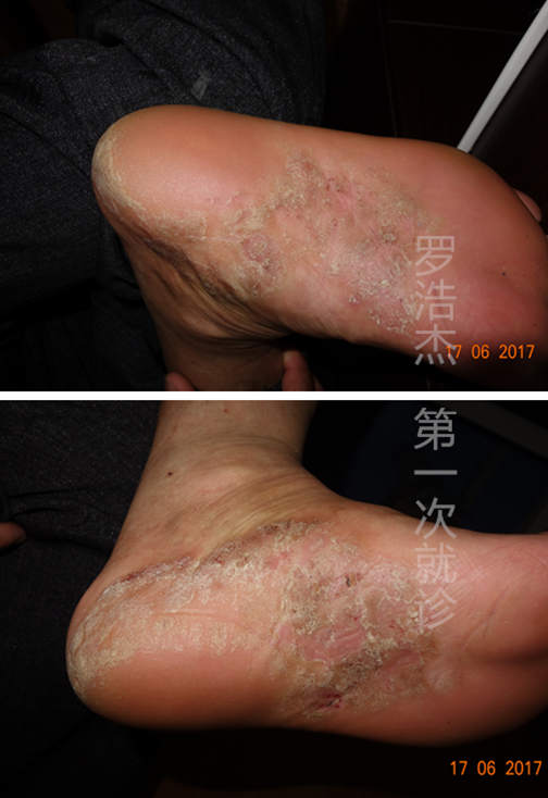 足底长期慢性湿疹(肥厚型)治愈案例 - 好大夫在线