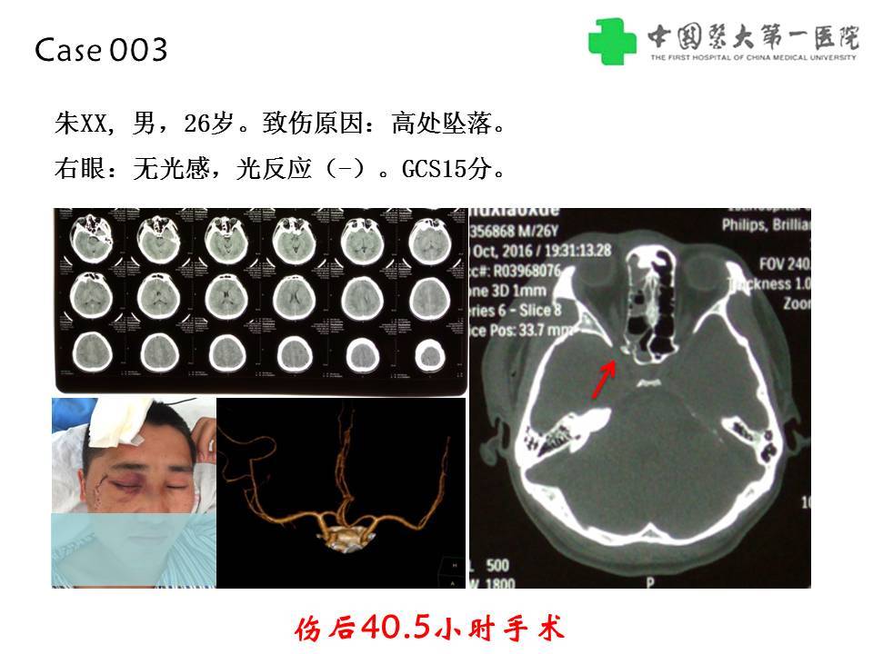 外伤后视神经管骨折后接受经鼻减压手术最佳时机如何