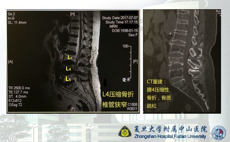 腰椎系列(二)压缩性骨折的微创治疗 —— 医学是什么?