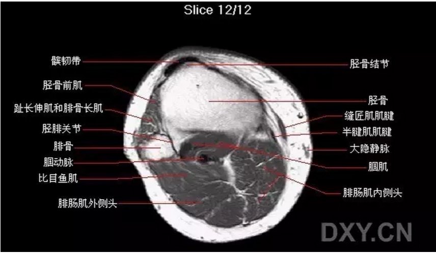 關節影像膝關節的磁共振mri解剖表現