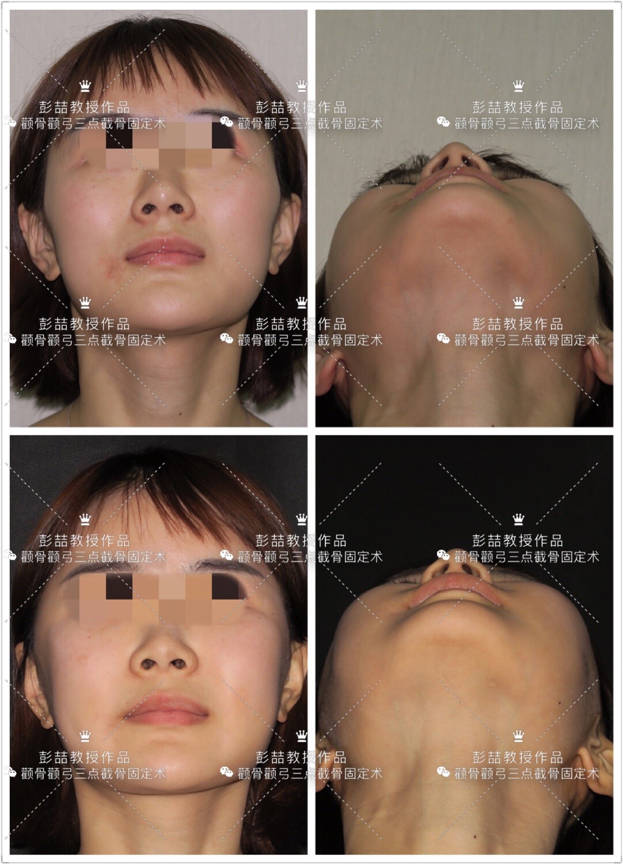 颧弓颧骨磨骨案例二