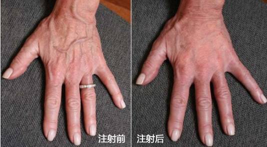 注射玻尿酸能丰"鸡爪手"吗? - 好大夫在线