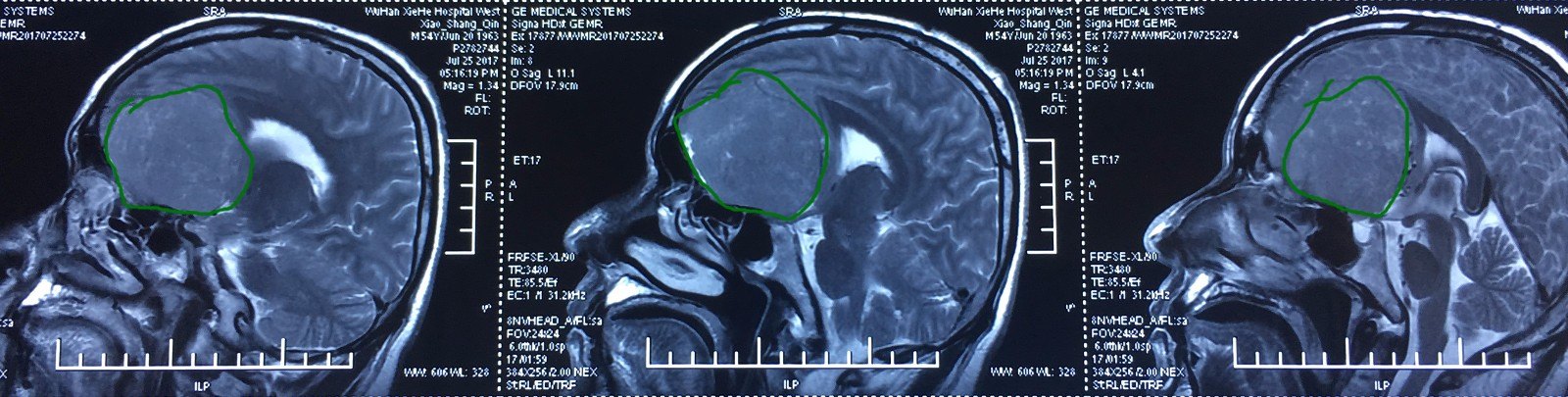 前顱窩底超級巨大腦膜瘤直徑9cm顯微外科切除