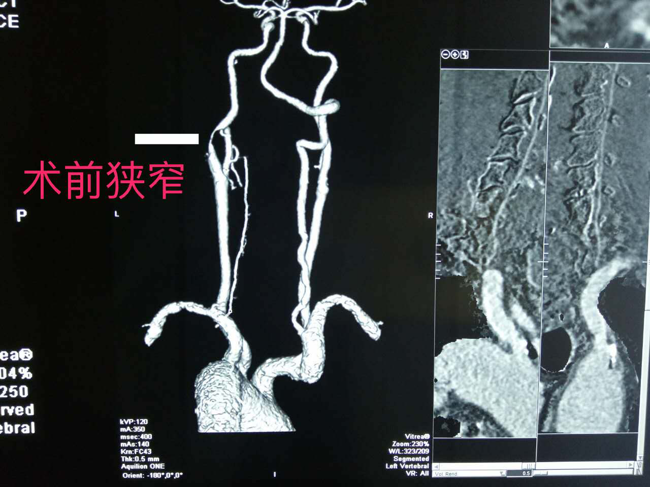 无症状颈动脉狭窄需要治疗吗