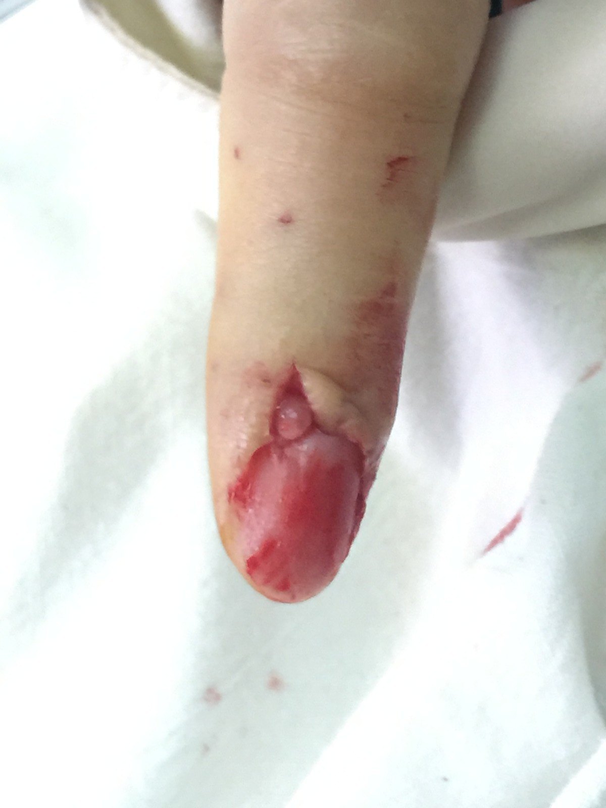 手指甲血管瘤图片图片